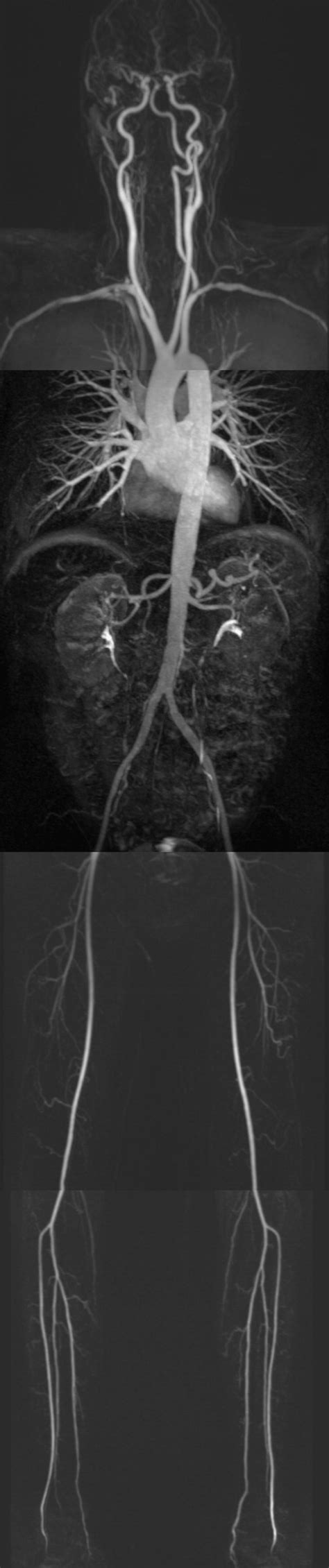 Whole Body Magnetic Resonance Angiography For Presurgical Planning Of