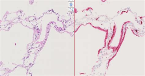 Anatomía patológica y análisis de imagen Ciencia carbónica