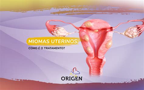 Miomas Uterinos Como O Tratamento Cl Nica Origen Fertiliza O