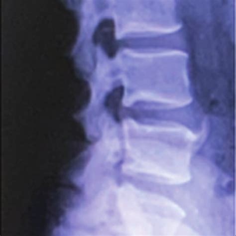 Lateral View Of L S Spine Suggestive Of Traumatic Listhesis And Grade