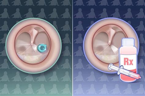 Tympanostomy Tubes for Recurrent Acute Otitis Media | NEJM Resident 360