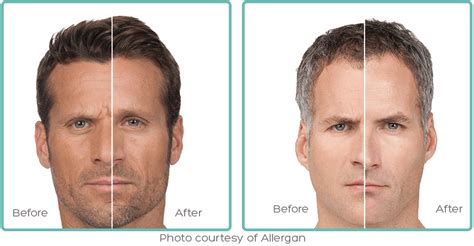 Botox Before And After Men