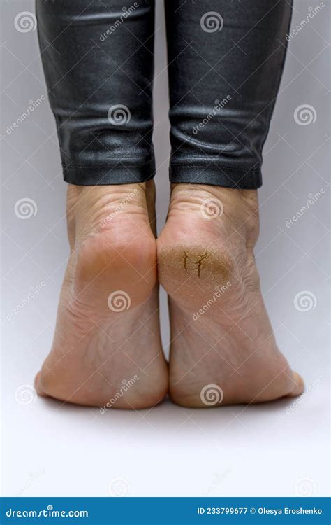 Cracked Heels Before And After Treatment And Treatment Medical