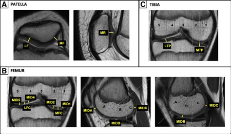 MRI measurements of articular cartilage thickness. Articular cartilage... | Download Scientific ...