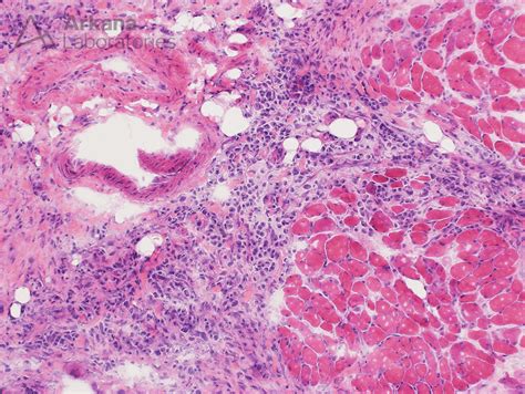 Signet Ring Carcinoma Arkana Laboratories