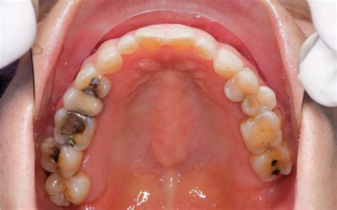 Amalgam Fillings Vs Composite Fillings For Tooth Cavities