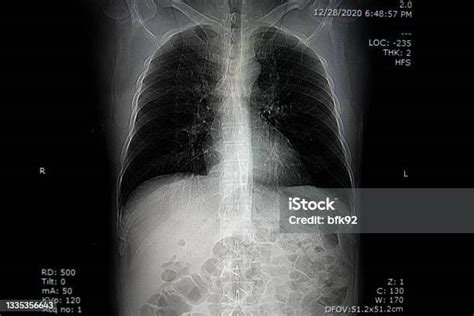 Computed Tomography Organ Dada Ct Scan Foto Stok Unduh Gambar