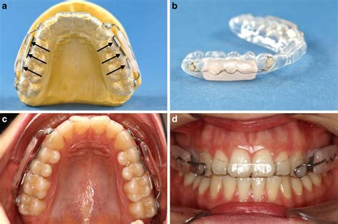 A Occlusal Splint With Laterally Fixed Specimens Arrows And