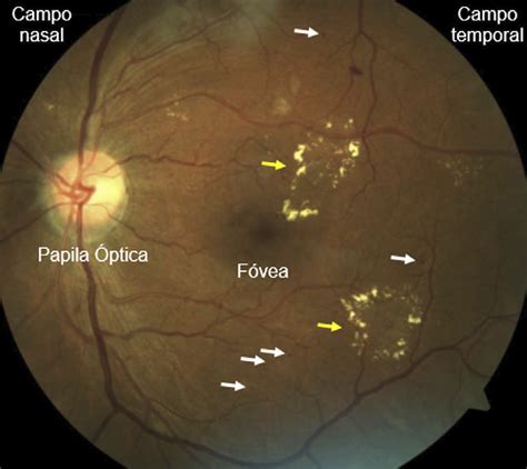 SciELO Brasil Retinografia Como Forma De Rastreio De Retinopatia