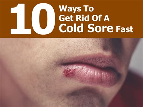 10 Ways To Get Rid Of A Cold Sore Fast