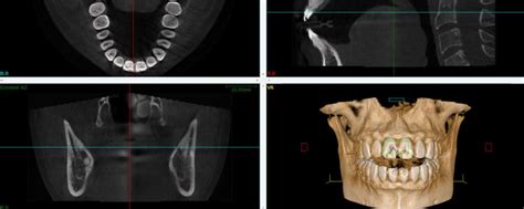 Cone Beam Essentiel En Implantologie Dentaire Sourire Dentaire