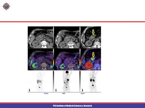 Pancreatic Tumours Radiology Imaging Pptx