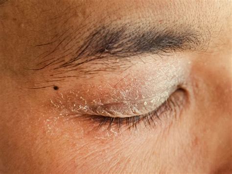 Understanding Dry Eyelids Causes Symptoms And Relief Phonemantra