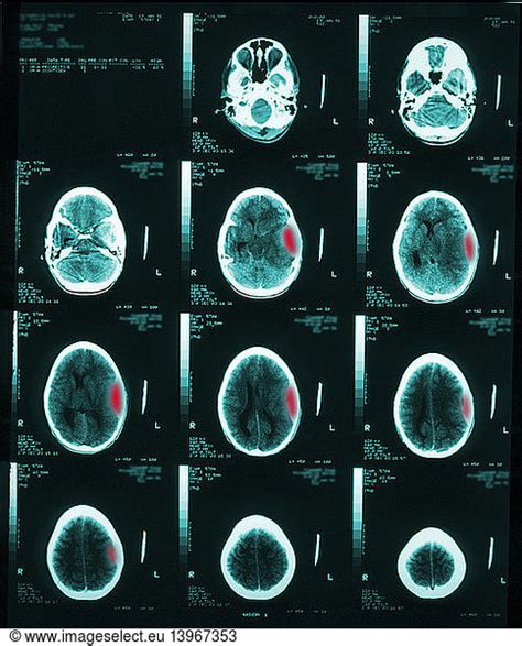 Cerebral CT Showing Subdural Hematoma Cerebral CT Showing Subdural