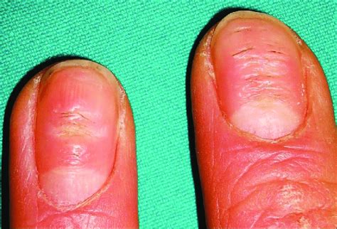 Nail pitting and transverse ridging in a patient with psoriasis ...