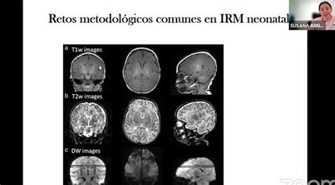 Resonancia Magn Tica De Cerebro Normalidad Y Anormalidad