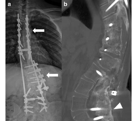 Stabilization Construct For Deformity Correction Scoliosis