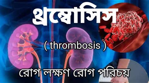 থরমবসস thrombosis of the heart জটল রগ Desh ma homeo by