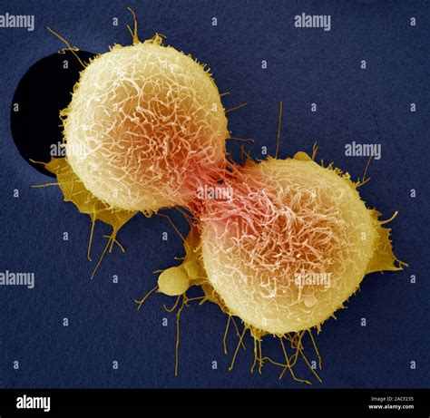 Cervical Cancer Cell Division Coloured Scanning Electron Micrograph