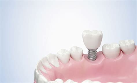 Complete Teeth Replacement The Perks Of Dental Implants Explained