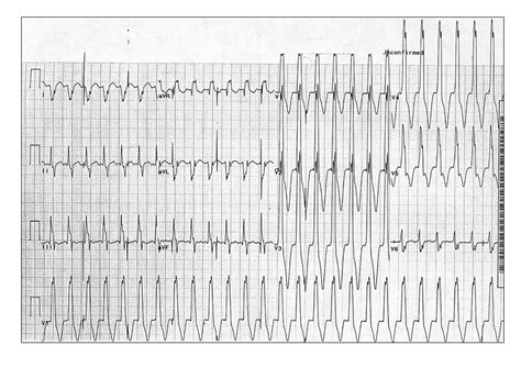 Differential Diagnosis Of Wide Qrs Complex Tachycardias The