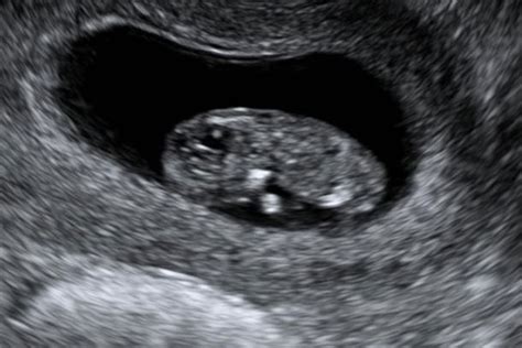 Ultrasound Services 7 Weeks Ultrasound Services