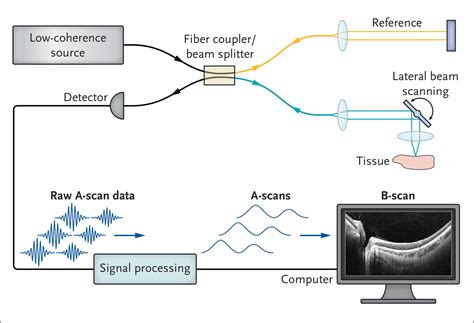 Optical Coherence Tomography And Eye Care New England Journal Of Medicine