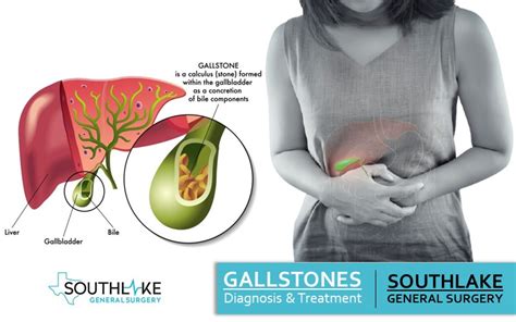 Gallbladder Diseases Types Symptoms And Treatment Southlake Texas