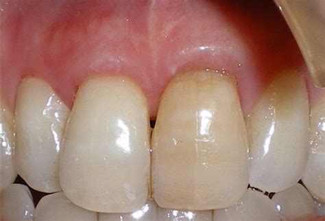 Replace Missing Bone Or Gum Tissue The California Society Of Periodontists