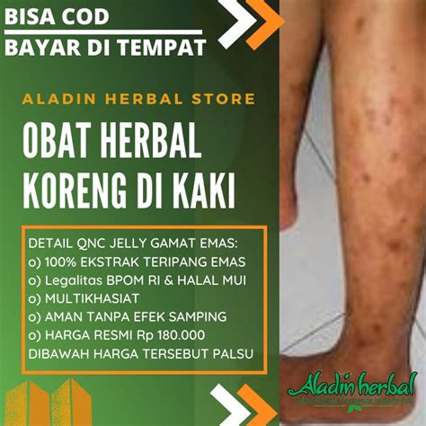 Jual COD Obat Koreng Di Kaki Khusus Korengan Menahun Budug