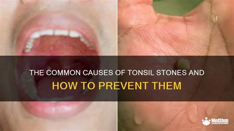 The Common Causes Of Tonsil Stones And How To Prevent Them Medshun