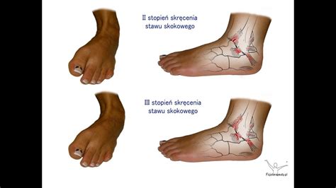 Przyczyny Rodzaje Objawy I Leczenie Skr Cenia Stawu Skokowego Mobile