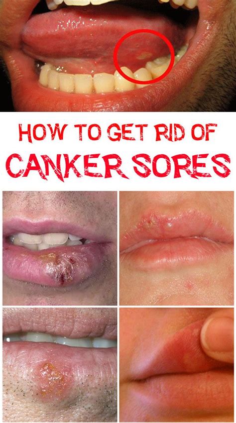 How To Get Rid Of Canker Sores On Tongue Canker Sore Canker Sore On