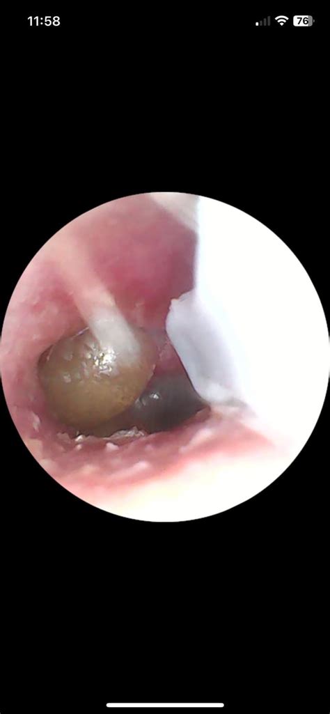 Ear infection? : r/Sinusitis