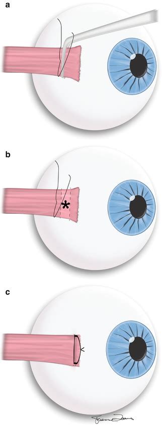 Imaging Of Strabismus And Craniofacial Malformation Surgery Radiology Key