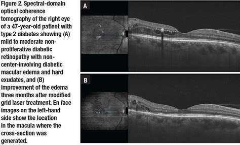 Clinically Significant Macular Edema Oct