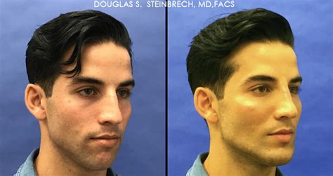 Male Model Makeover The Hottest Procedure Amongst Millennial Men New Theory Magazine