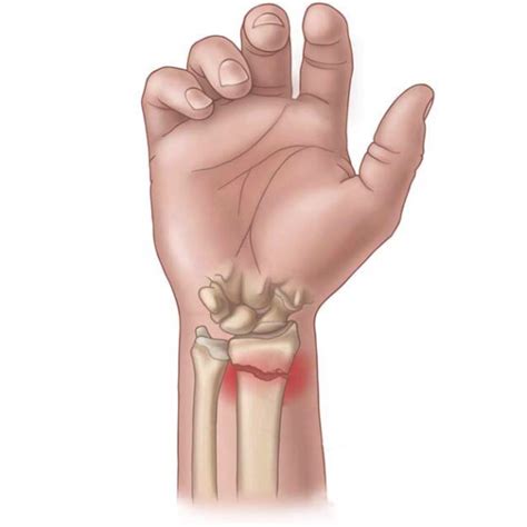 Fratura Do R Dio E Ulna Grupo De Cirurgia Da M O E Microcirurgia