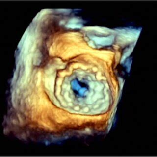 Transesophageal Echocardiography Showing Tendynetm Valve Abbott After