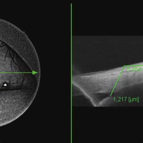 Swept Source Optical Coherence Tomography Ss Oct Image From A