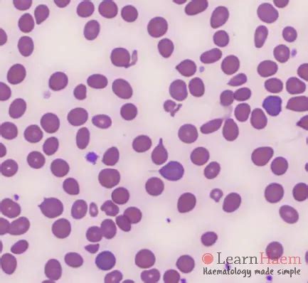 Teardrop Cells - LearnHaem | Haematology Made Simple