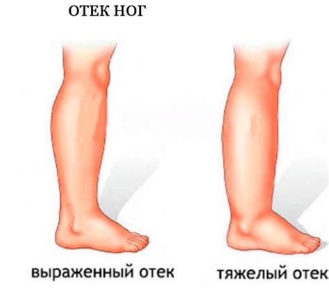 Кардиосклероз: что это такое, как его как лечить, симптомы