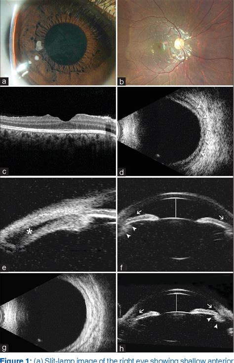 Bilateral Secondary Angle Closure Glaucoma And Ciliochoroidal Effusion As An Initial