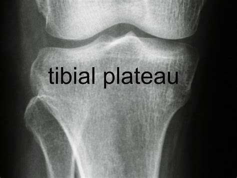 Croquis Plateau Tibial Hot Sex Picture