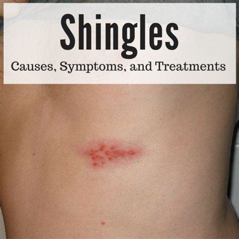 Stages Of Shingles What Causes Shingles Shingles Rash Facial Shingles Health Info Health