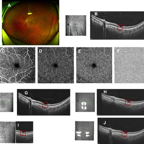 Fundus Images Of The Left Eye In Case Fundus Photography A And