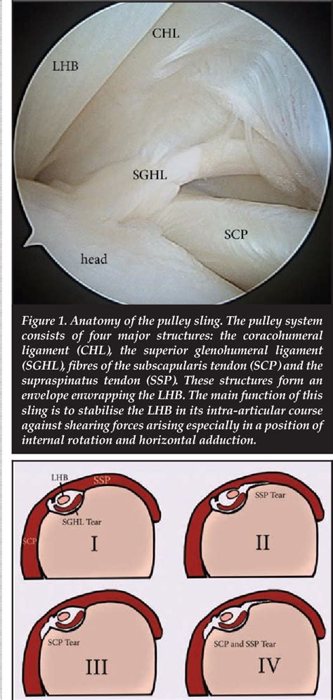 Figure 1 From Biceps Pulley Lesions Associated With Subscapularis Tears And Subacromial