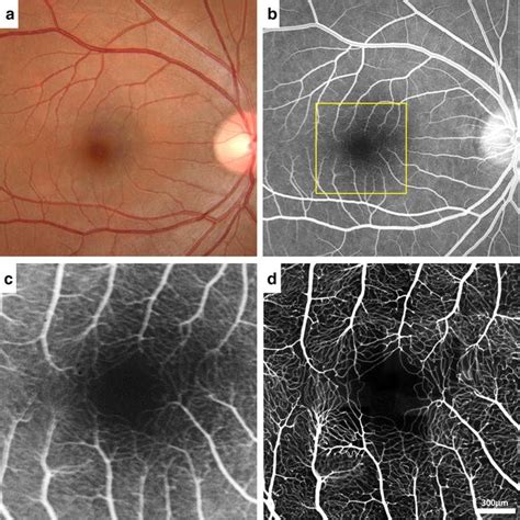 Human Retinal Microvascular Imaging Using Adaptive Optics Scanning