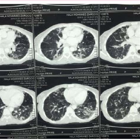 Ct Chest Of The Patient Shows Bilateral Septal Thickening Ground Glass Download Scientific