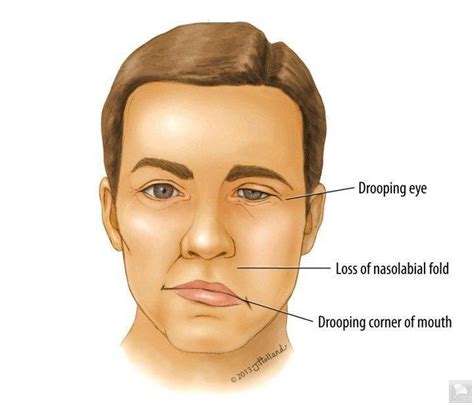 Bell's Palsy Symptoms : Bell'S Palsy - In most cases, the weakness is ...